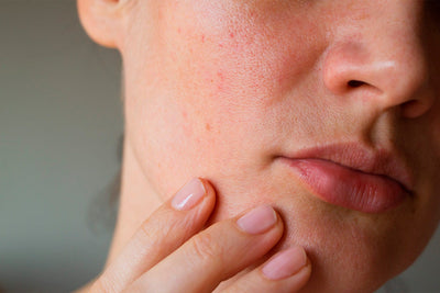 Why Your Skin Gets Oilier in Summer—And How to Control It